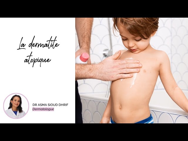 Video Vidéo conseil-le dermatite atopique chez les enfants