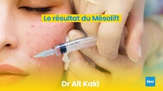 فيديو Le résultat du Mésolift 