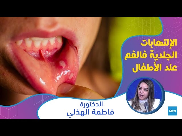 Video الإلتهابات الجلدية فالفم عند الأطفال 
