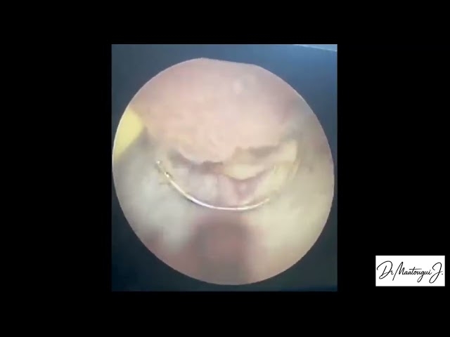 Video Ne jamais ignorer la présence de sang dans les urines, ça peut révéler un CANCER de la VESSIE
Dr Maatougui Jasser - Chirurgien Urologue