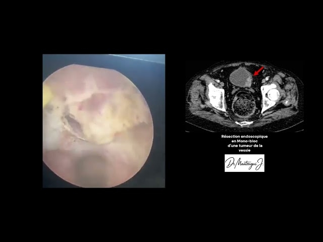 Video Résection endoscopique d'une tumeur vésicale (RTUV) en Monobloc
Dr Maatougui Jasser - Chirurgien Urologue