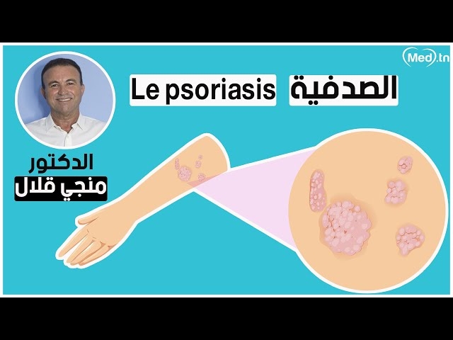 Video Psoriasis