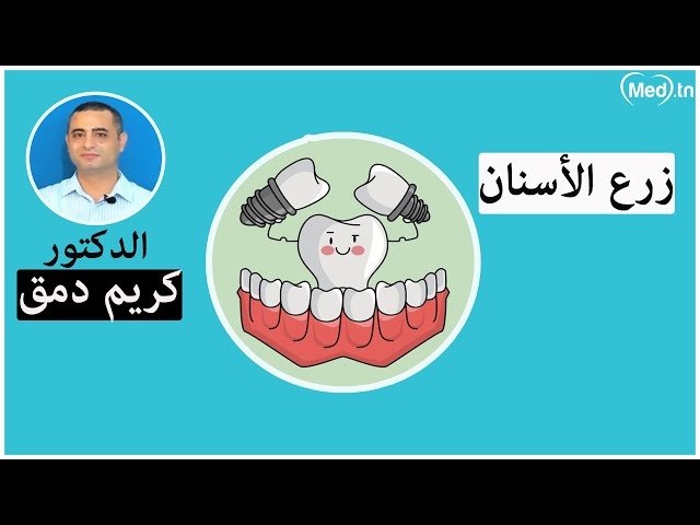فيديو زرع الأسنان
