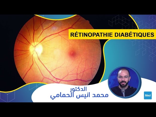 فيديو Rétinopathie diabétiques