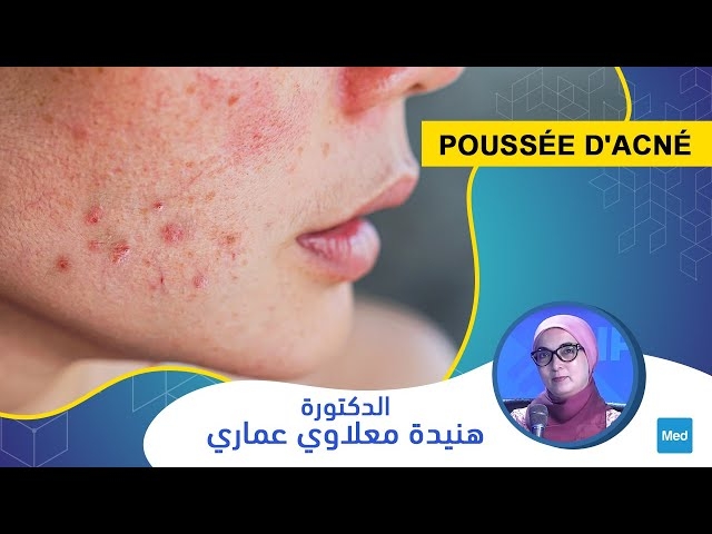 فيديو Poussée d'acné