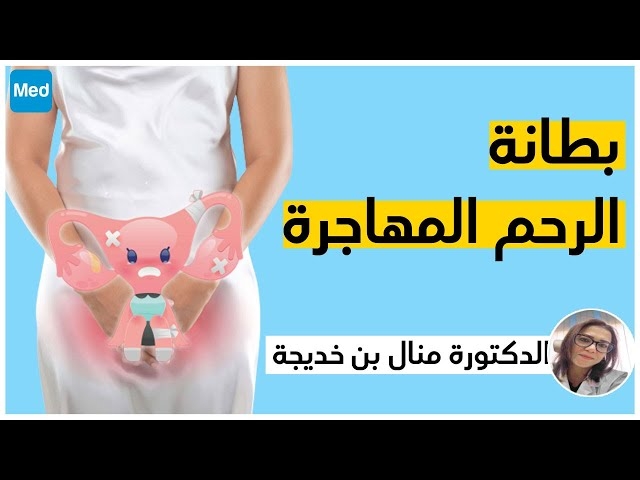 فيديو بطانة الرحم المهاجرة  : L'endométriose 