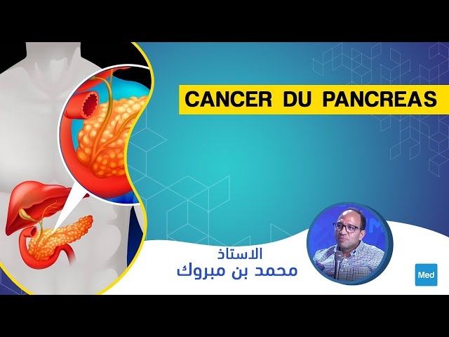 Video Cancer du pancréas