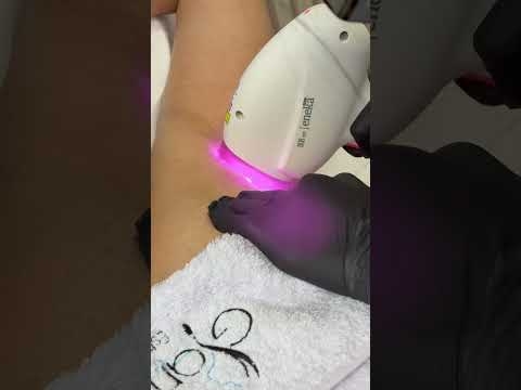 Video Épilation au laser des aisselles sans douleur
