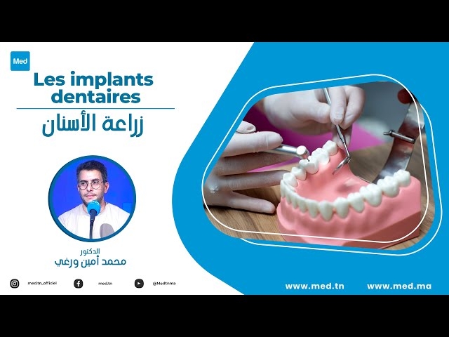 Video Les implants dentaires