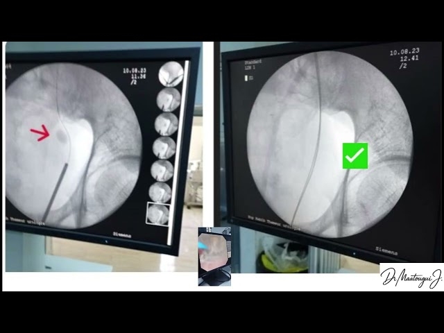 Video Vous souffrez d’un calcul urétéral ?  L’urétéroscopie laser est la solution pour vous.
Dr Maatougui Jasser - Chirurgien Urologue