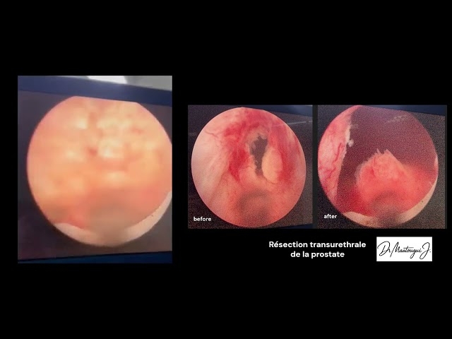 Video Résection endoscopique transuréthrale de la prostate (RTUP).
Dr Maatougui Jasser - Chirurgien Urologue