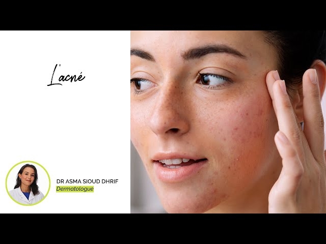 فيديو L'acné
