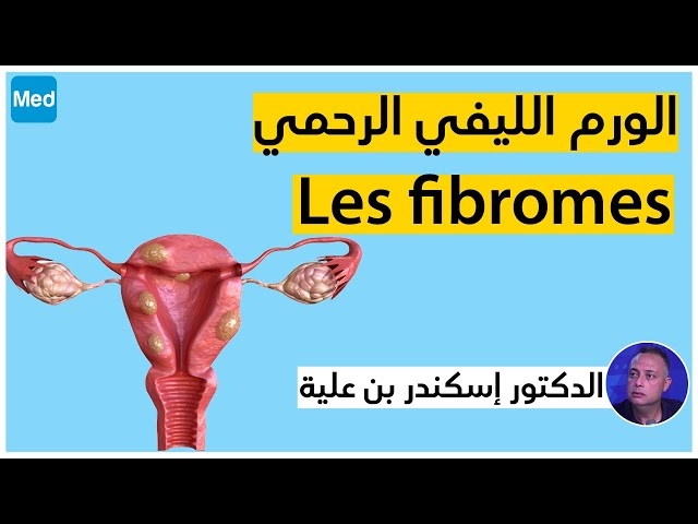 Video Les fibromes utérins