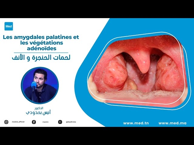 Video Les amygdales palatines et les végétations adénoïdes
