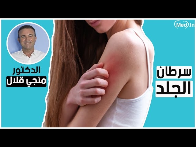 فيديو مرض سرطان الجلد