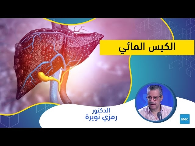 Video الكيس المائي