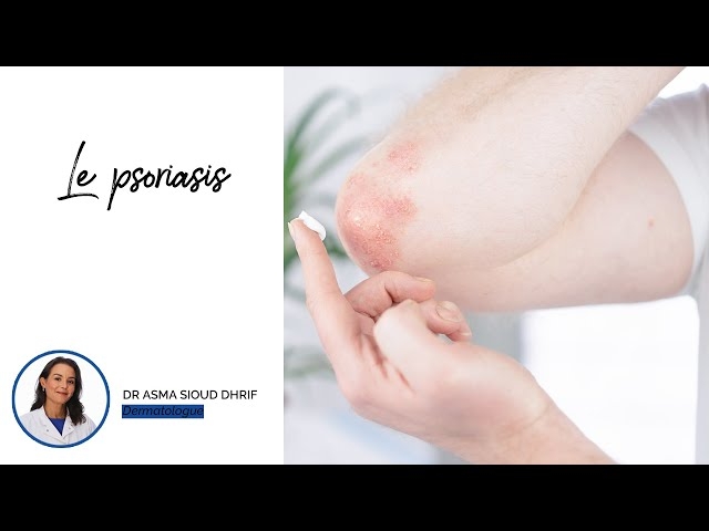 Video Le psoriasis