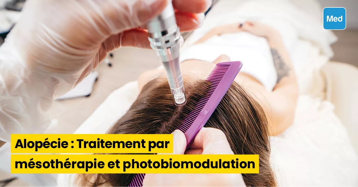 Alopécie : Traitement par mésothérapie et photobiomodulation