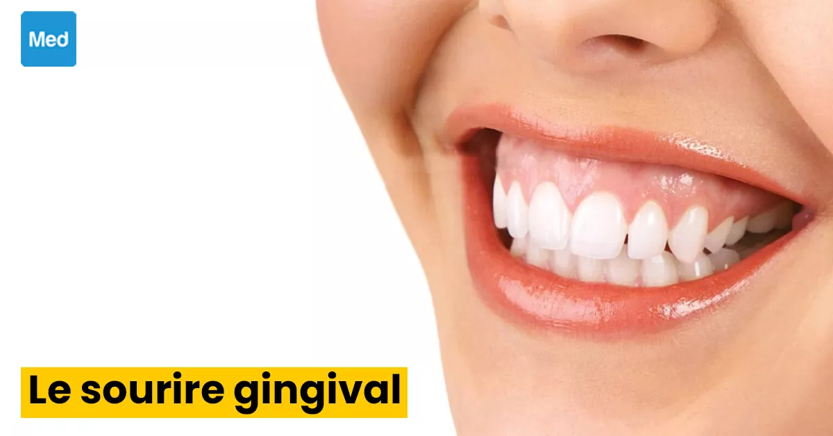 Le sourire gingival ou gummy smile