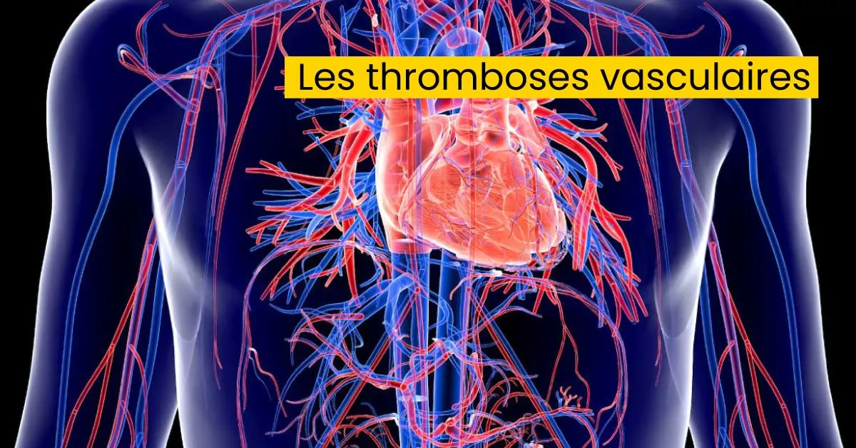Les thromboses vasculaires