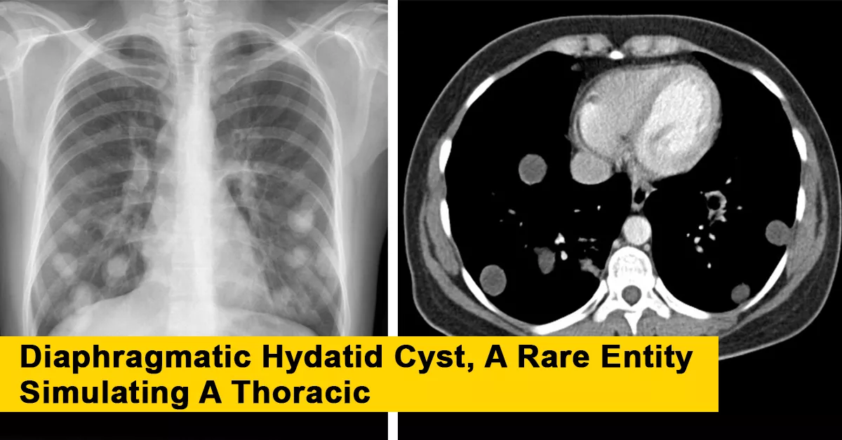 Diaphragmatic Hydatid Cyst, A Rare Entity Simulating A Thoracic
