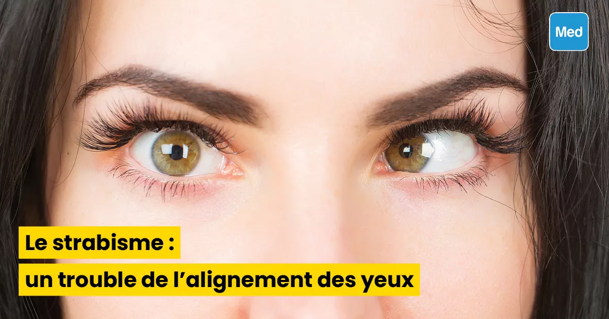 Le strabisme : un trouble de l'alignement des yeux