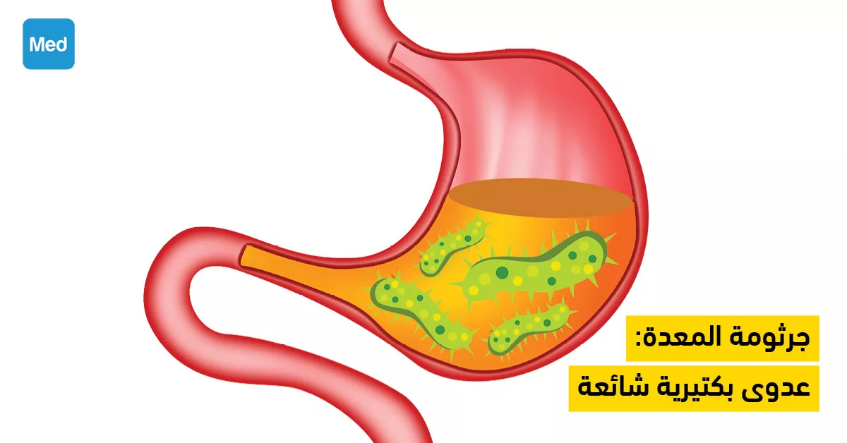 جرثومة المعدة: عدوى بكتيرية شائعة