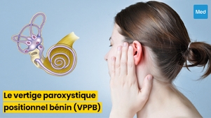 Le Vertige Paroxystique Positionnel Bénin (VPPB)