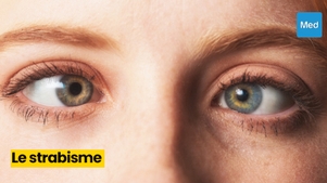 Le strabisme : un trouble oculaire qui mérite d'être pris au sérieux