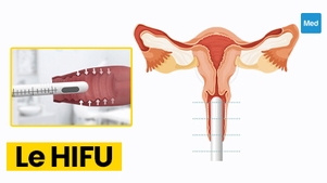 HIFU gynécologique : une nouvelle technique prometteuse