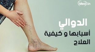 Magazine الدوالي أسبابها و كيفية العلاج