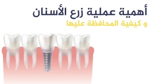 المجلة الطبية أهمية عملية زرع الأسنان و كيفية المحافظة عليها