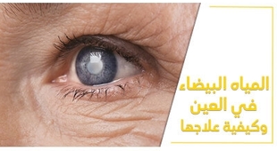 المجلة الطبية المياه البيضاء في العين وكيفيّة علاجها