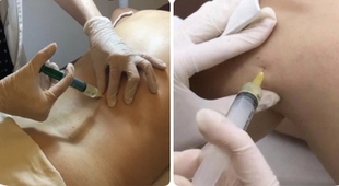Makaleler La mésothérapie, une technique de pointe pour soulager la douleur