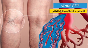 المجلة الطبية التخثر الوريدي : الأسباب ، الأعراض وطرق العلاج