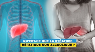 المجلة الطبية Qu'est-ce que la stéatose hépatique non alcoolique ?