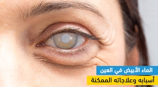 Makaleler الماء الأبيض في العين : أسبابه وعلاجاته الممكنة