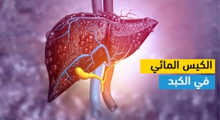 Makaleler الكيس المائي في الكبد