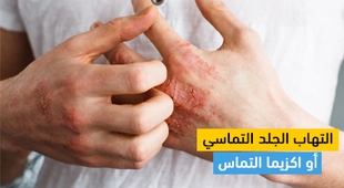 Makaleler التهاب الجلد التماسي أو اكزيما التماس