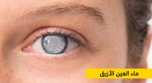المجلة الطبية ماء العين الأزرق