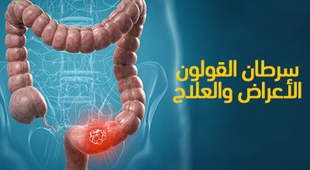 Makaleler سرطان القولون : الأعراض والعلاج
