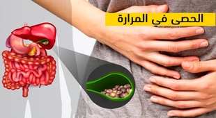 Makaleler الحصى في المرارة