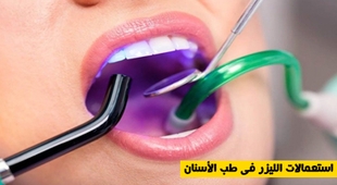 Makaleler استعمالات الليزر في طب الأسنان