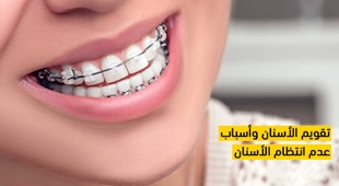 Magazine تقويم الأسنان وأسباب عدم انتظام الأسنان
