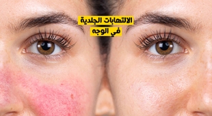 المجلة الطبية الالتهابات الجلدية في الوجه