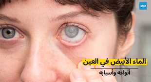 المجلة الطبية الماء الأبيض في العين : أنواعه وأسبابه