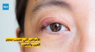 Makaleler الأمراض التي تصيب محجر العين والجفون