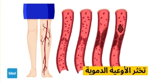 Makaleler تخثر الأوعية الدموية