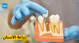 المجلة الطبية زراعة الأسنان