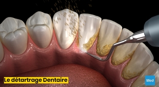 Magazine Détartrage Dentaire : Le Secret d'un Sourire Sain et Éclatant